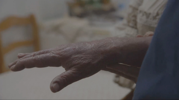 Linfoma Cutâneo de Células T (LCCT)