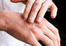 Dermatite Atópica afeta sono, saúde mental e vida social de milhões de pessoas