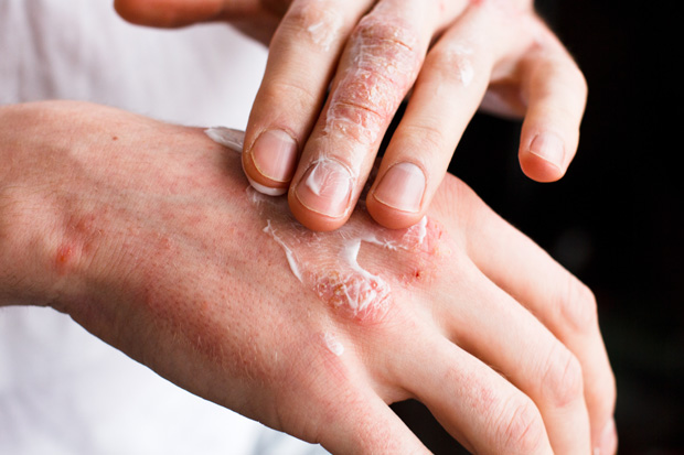 dermatite_atopica_hospital_fernando_fonseca